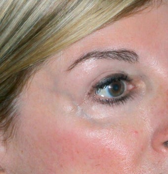 Laser vein removal before 374354