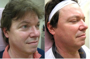 Intense pulsed light (IPL) before 363581