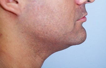 Neck liposuction before 68525