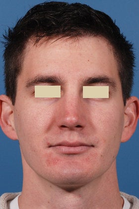 Rhinoplasty after 154298