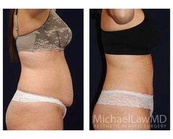 Abdominoplasty - Tummy Tuck 396091