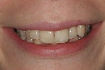 Smile Makeover with Invisalign before 94816