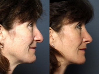 Rhinoplasty before 339184