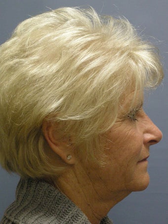 Obagi Blue Peel 635081