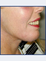 Neck Lift and Chin Implant after 87077