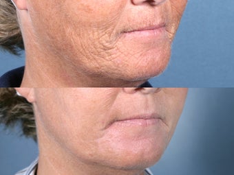 Laser Resurfacing for mouth wrinkles before 104656