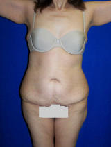 Extended Tummy Tuck Surgery before 136219