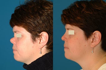 Saddle Nose / Collapsed Nose Rhinoplasty before 117298