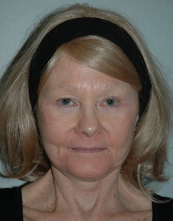 High SMAS Face Lift, Neck Lift, Perioral Dermabrasion after 468008