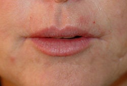 Restylane injections for upper lip lines after 91656