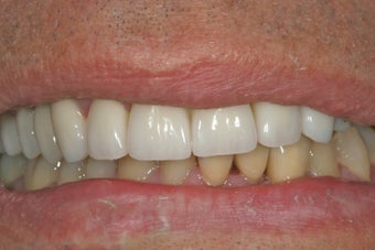 Dental implants, bone graft, all porcelain crowns and veneers after 503162
