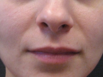 Sculptra injections after 272063
