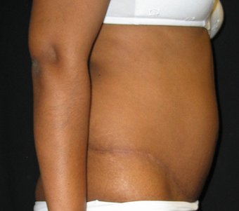 Abdominoplasty 458934