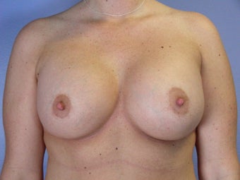 Breast Lift / Breast Augmentation after 290987
