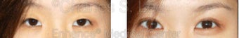 Blepharoplasty before 427710