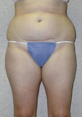 Lower Body Lift before 410338