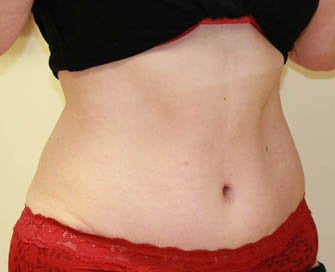 Abdominoplasty (Tummy Tuck) after 232368