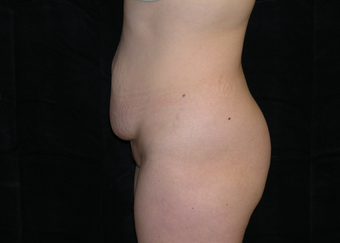 Abdominoplasty 476707