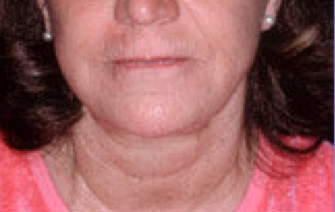 Extreme filler a.k.a liquid facelift after 316574