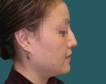 Nose Surgery -Rhinoplasty 519261