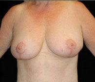 Breast Lift after 633839