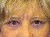Brow Lift after 541479