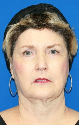 1 month post op: Facelift, Necklift, Browlift, Fat Transfer, Upper Bleph before 456304