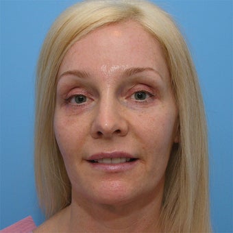 Brow Lift with Upper and Lower Blepharoplasty after 553455
