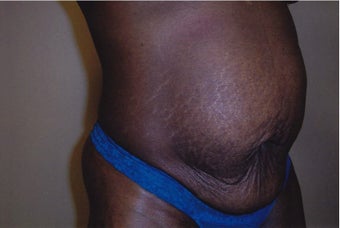 Tummy Tuck before 245219
