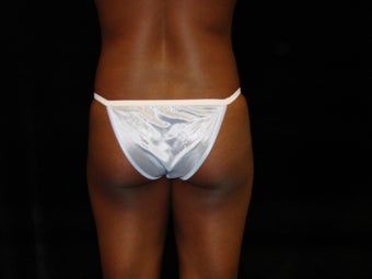Buttocks Augmentation before 222674