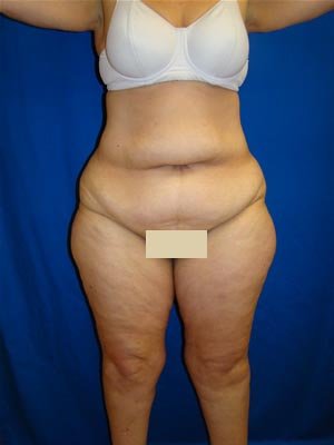 Extended Tummy Tuck Surgery before 139428