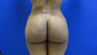 Brazilian Butt Lift/Fat Grafting Buttock Augmentation after 599828