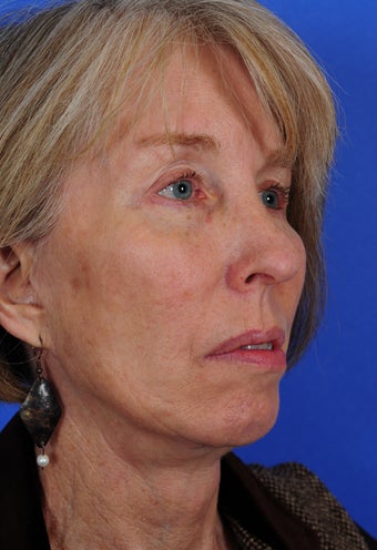 Face Lift after 322007