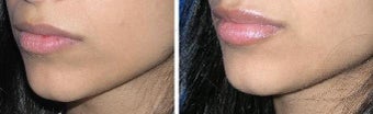 Lip Augmentation before 165800