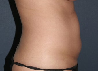 Liposculpture before 486622