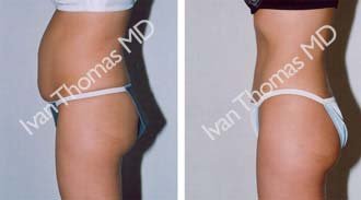 Tummy Tuck before 242536