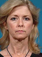 Face/neck/brow lift, upper/lower eyelid surgery before 458800