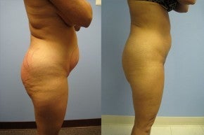 SmartLipo Triplex before 534895