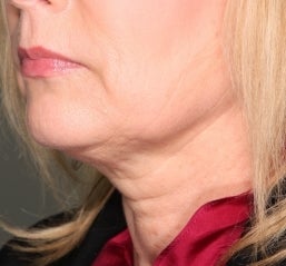 Ultherapy 582605