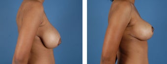 Breast Reduction after 355740