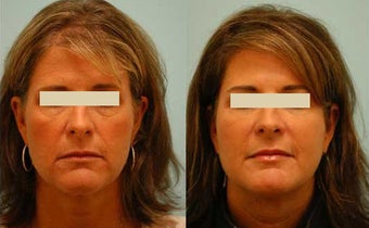 Fat Transfer/Fat Grafting/Facial Rejuvenation before 136343