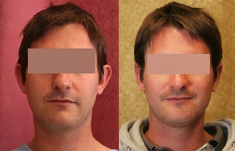 Otoplasty or ear push back surgery after 583658
