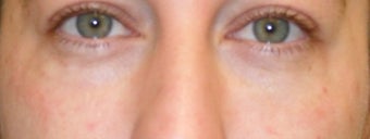 Under eye bag treatment after 151901