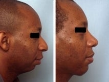 Rhinoplasty before 130772