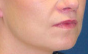 Lift Lip 635458