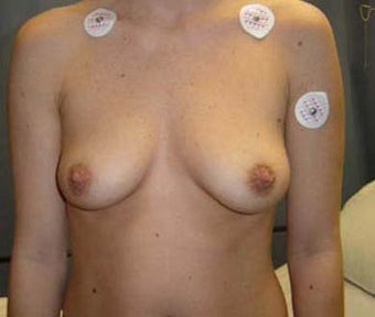 Breast Augmentation before 131651