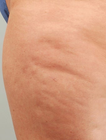 Smart Lipo before 606715