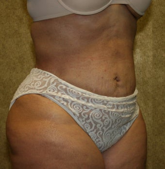 liposuction of abdomen and flanks after 582260