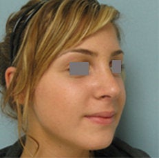Rhinoplasty after 134004