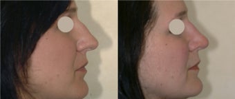 Before and After Rhinoplasty before 87078